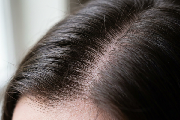 Signs of an Unhealthy Scalp You’re Probably Ignoring